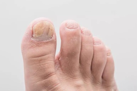 The Difference Between Nail Psoriasis and Nail Fungus