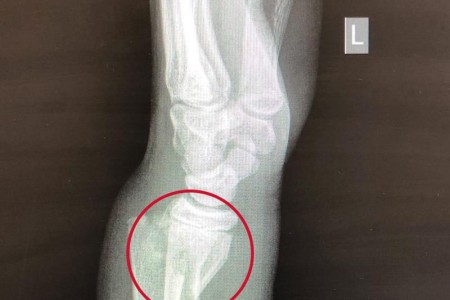 Smith Fracture