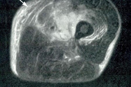Pyomyositis