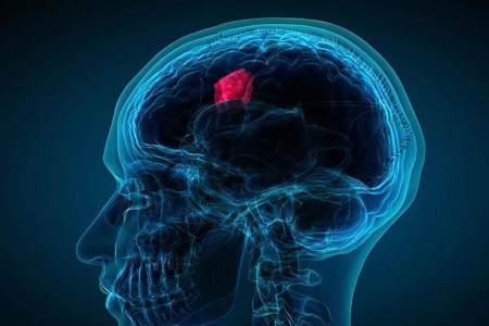 What Are the Actual Warning Signs of a Brain Tumor?