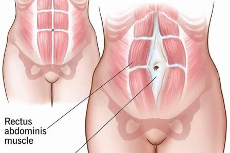 Diastasis Recti