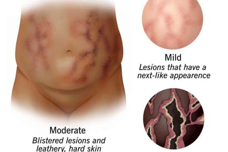 Calciphylaxis