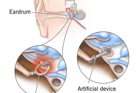 Stapedectomy