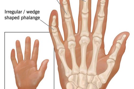 Clinodactyly