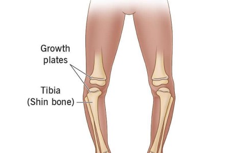 Blount’s Disease