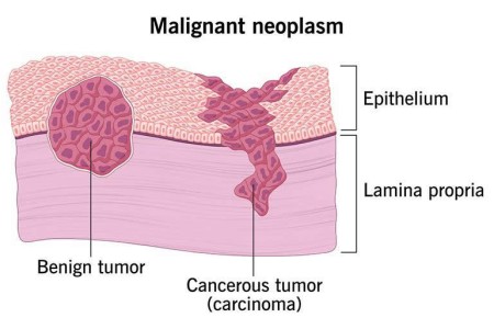 Malignant Neoplasm