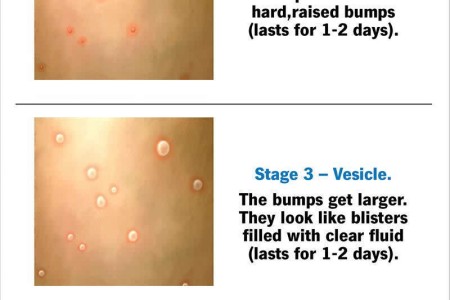 Mpox