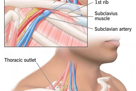 Venous Thoracic Outlet Syndrome