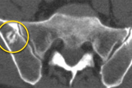 Bone Island (Enostosis)