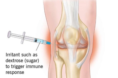 Prolotherapy