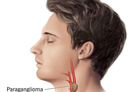 Paraganglioma