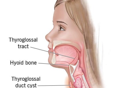 Thyroglossal Duct Cysts in Children & Adults
