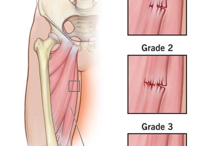 Muscle Strain