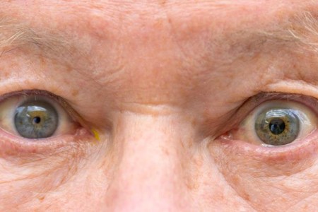 Anisocoria