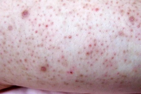 Bumps on Your Arms? Here’s How To Get Rid of Them