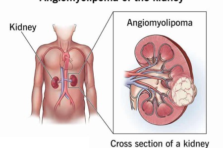 Angiomyolipoma of the Kidney
