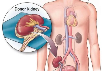 Kidney Transplant