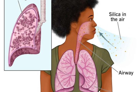 Silicosis
