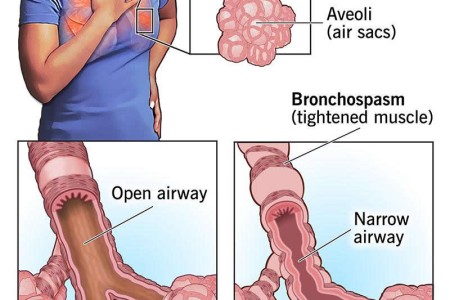 Bronchospasm