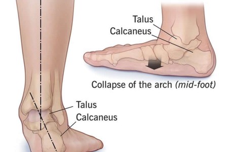 Overpronation