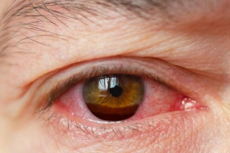 Hyphema