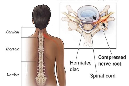 Radiculopathy