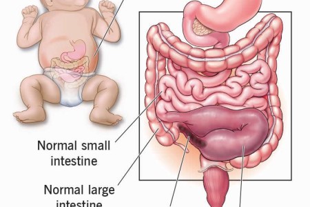 Meconium Ileus
