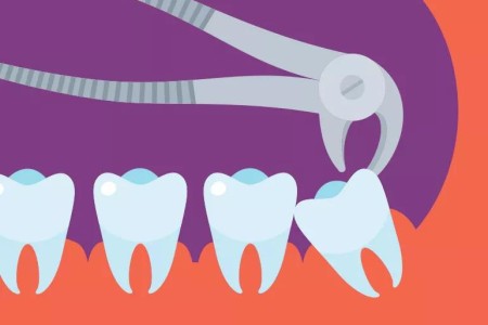 What To Do After Wisdom Teeth Removal