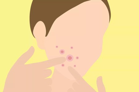 Pimple Popping 101: How to (Safely) Zap Your Zits