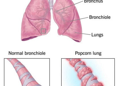 Popcorn Lung (Bronchiolitis Obliterans)