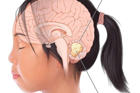 Medulloblastoma