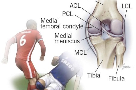 Hyperextended Knee