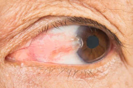 Pterygium (Surfer's Eye)