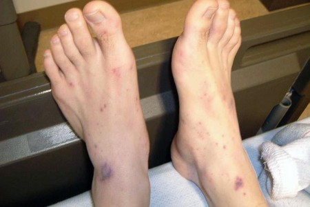 Meningococcal Disease