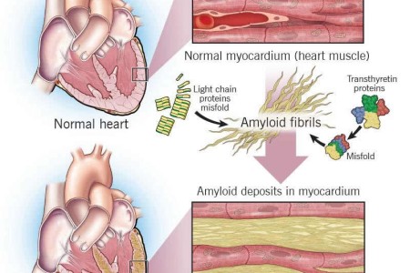 Cardiac Amyloidosis