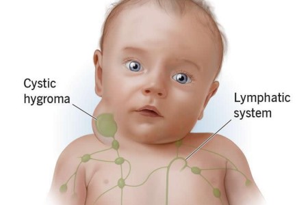 Cystic Hygroma