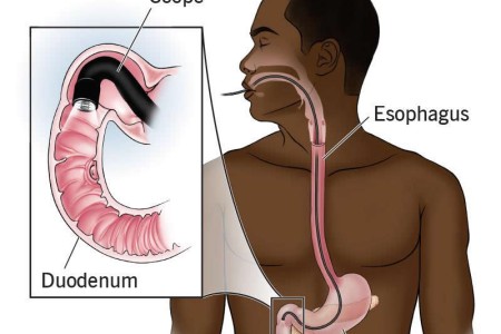 EGD Procedure (Upper Endoscopy)