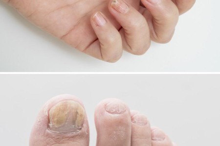 Dystrophic Nails