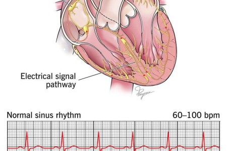 Sinus Bradycardia