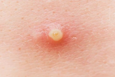 Infected Pimple