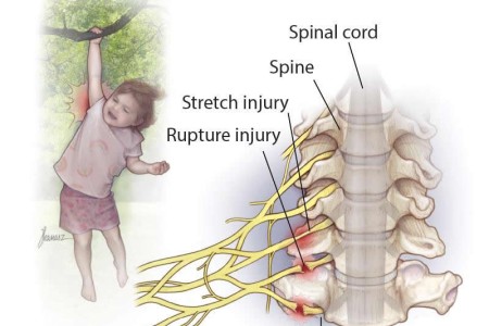 Brachial Plexus Injury