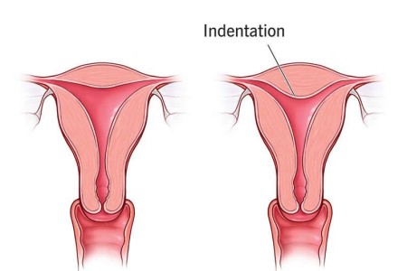 Arcuate Uterus
