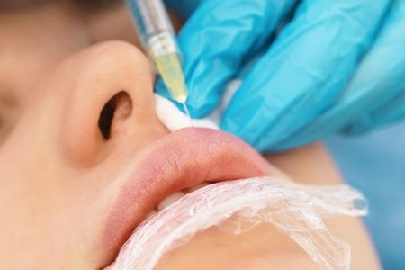 Lip Augmentation