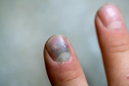 What To Do if Your Fingernail Gets Bruised (Or Falls Off)