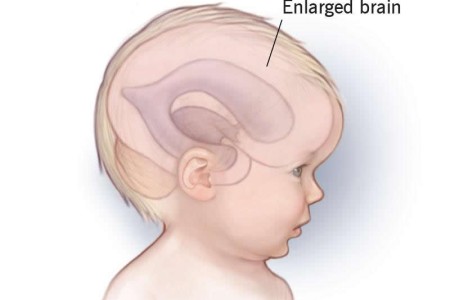 Macrocephaly