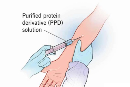 Tuberculosis (TB) Test