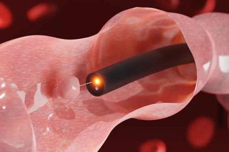 Do You Need Surgery To Remove Large Colorectal Polyps?