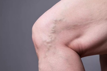 When To Worry About Varicose Veins