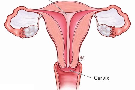 Septate Uterus