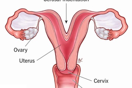 Bicornuate Uterus